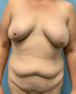 Before Image: Breast Lift and Fat Transfer