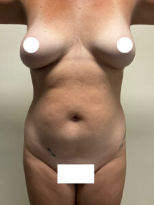 Tummy Tuck