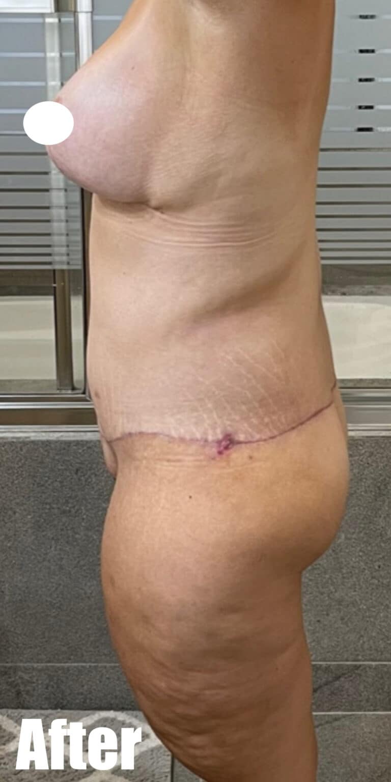 After Image: 33F Circumferential Tummy Tuck - left-side