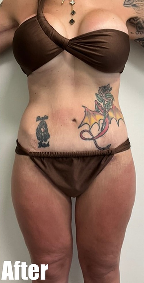 After Image: Crescent Thigh lift + Buttock Lift - front