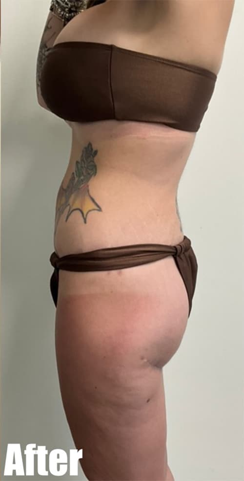 After Image: Crescent Thigh lift + Buttock Lift - left-side