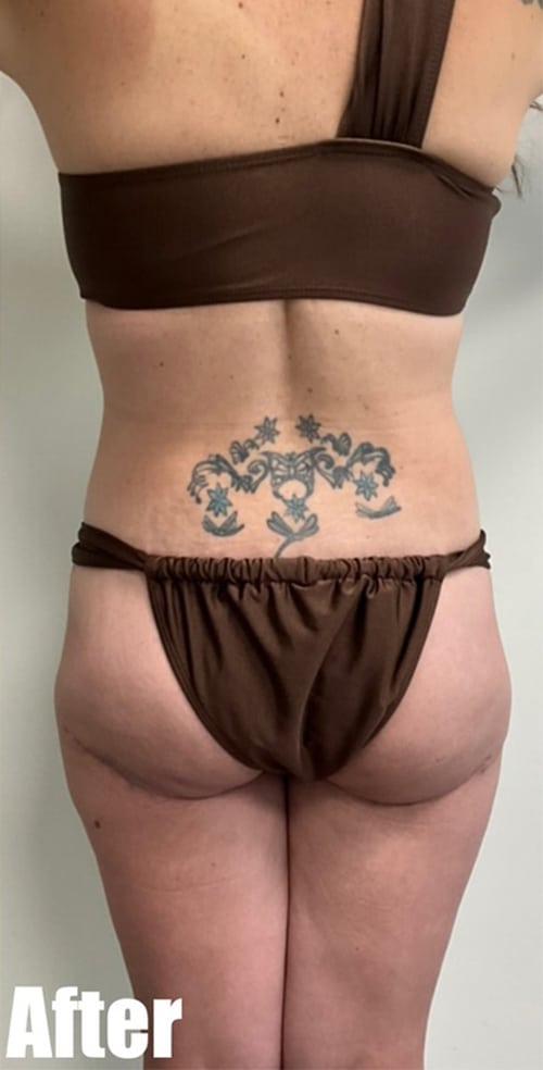 After Image: Crescent Thigh lift + Buttock Lift - back