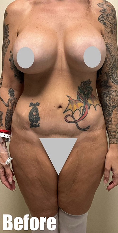 Before Image: Crescent Thigh lift + Buttock Lift - front