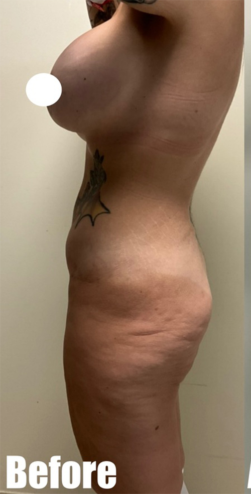 Before Image: Crescent Thigh lift + Buttock Lift - left-side
