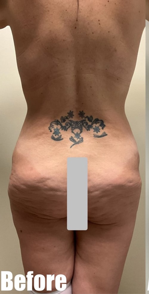 Before Image: Crescent Thigh lift + Buttock Lift - back