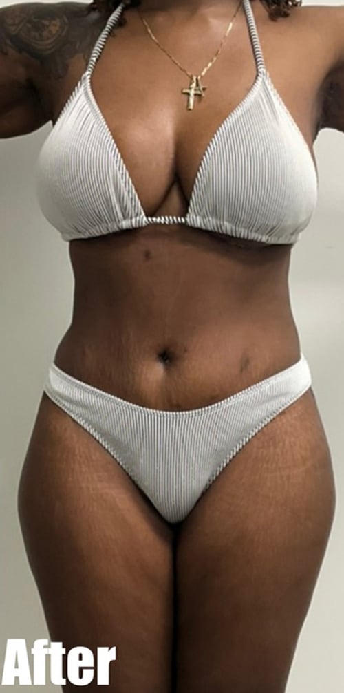 After Image: Circumferential Mamacita Makeover - front