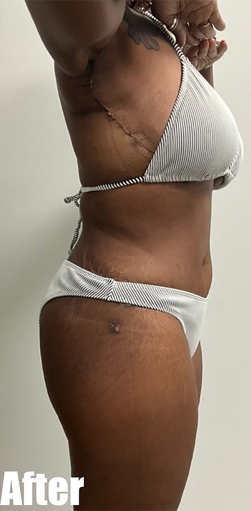 After Image: Circumferential Mamacita Makeover - right-side