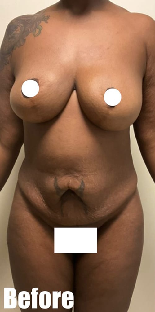 Before Image: Circumferential Mamacita Makeover - front