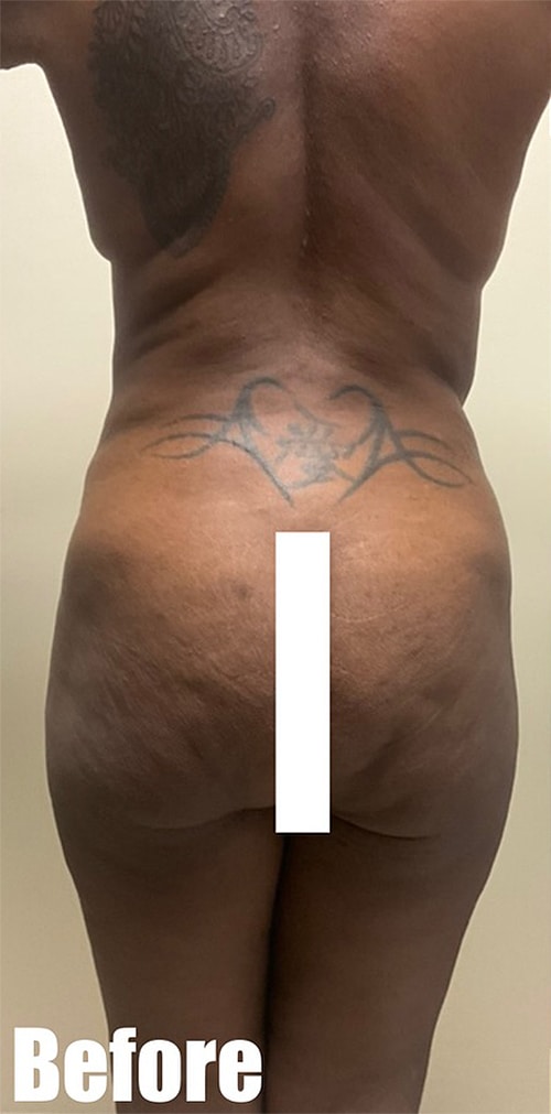 Before Image: Circumferential Mamacita Makeover - back