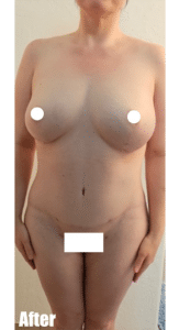 After Image: 44F Mommy Makeover