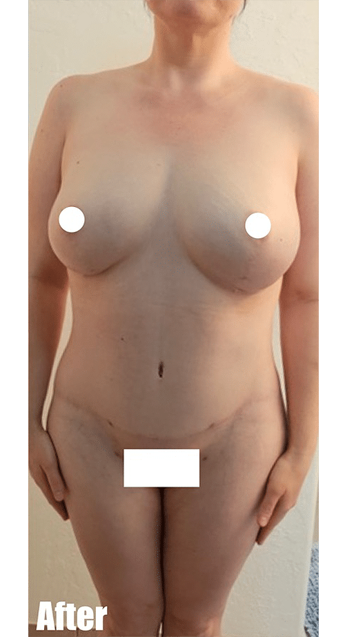 After Image: 44F Mommy Makeover - front