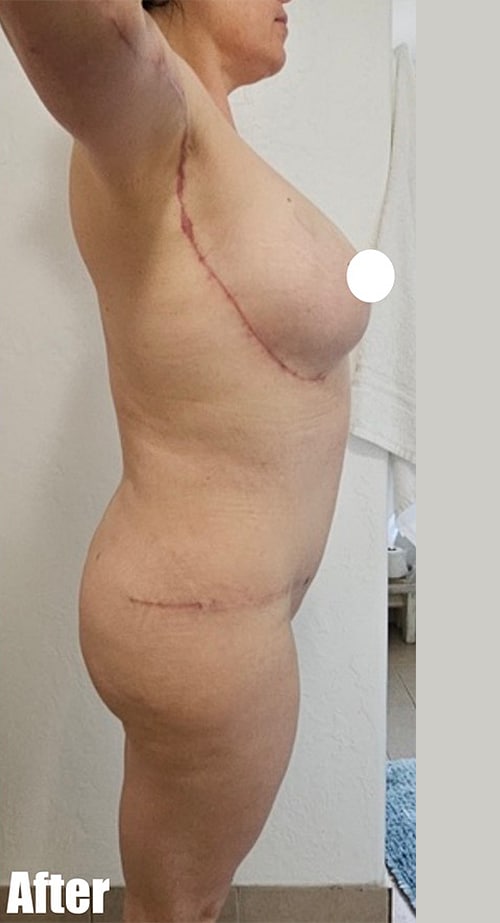 After Image: 44F Mommy Makeover - right-side