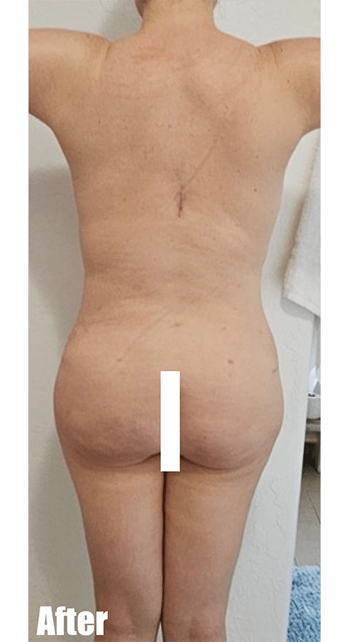 After Image: 44F Mommy Makeover - back