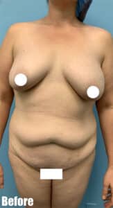 Before Image: 44F Mommy Makeover