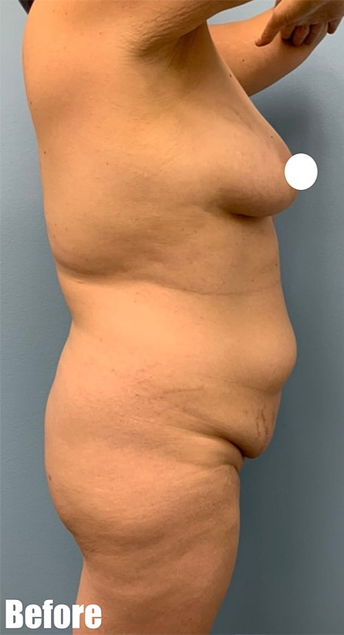 Before Image: 44F Mommy Makeover - right-side