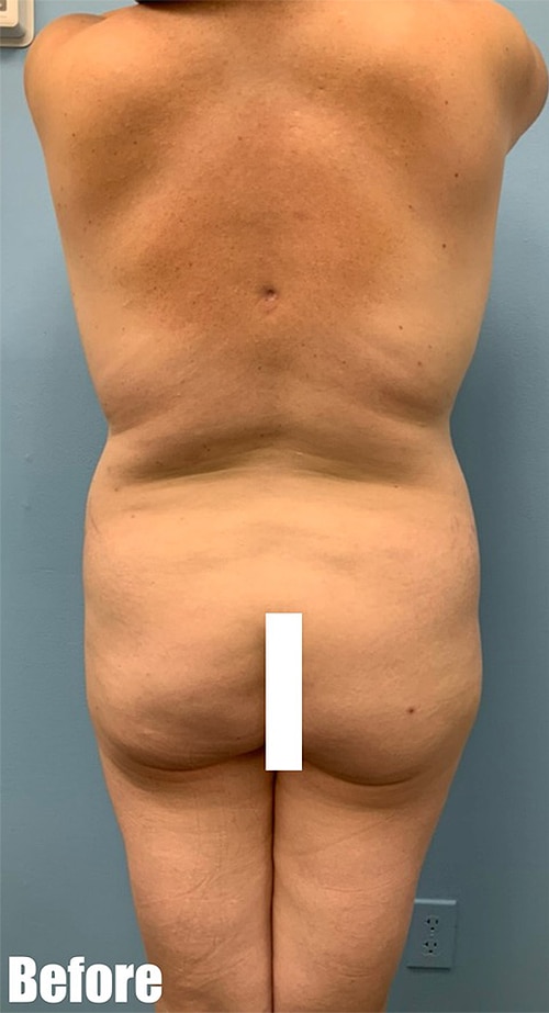 Before Image: 44F Mommy Makeover - back