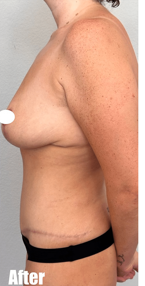 After Image: 38F Mommy Makeover - left-side
