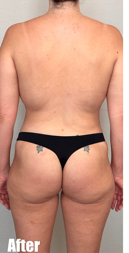After Image: 38F Mommy Makeover - back
