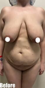 Before Image: 38F Mommy Makeover