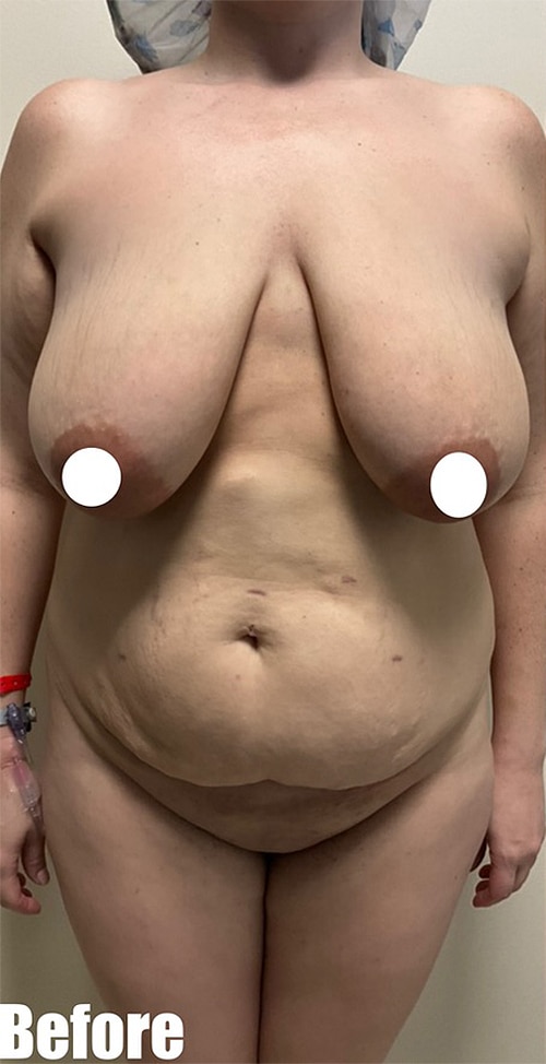 Before Image: 38F Mommy Makeover - front