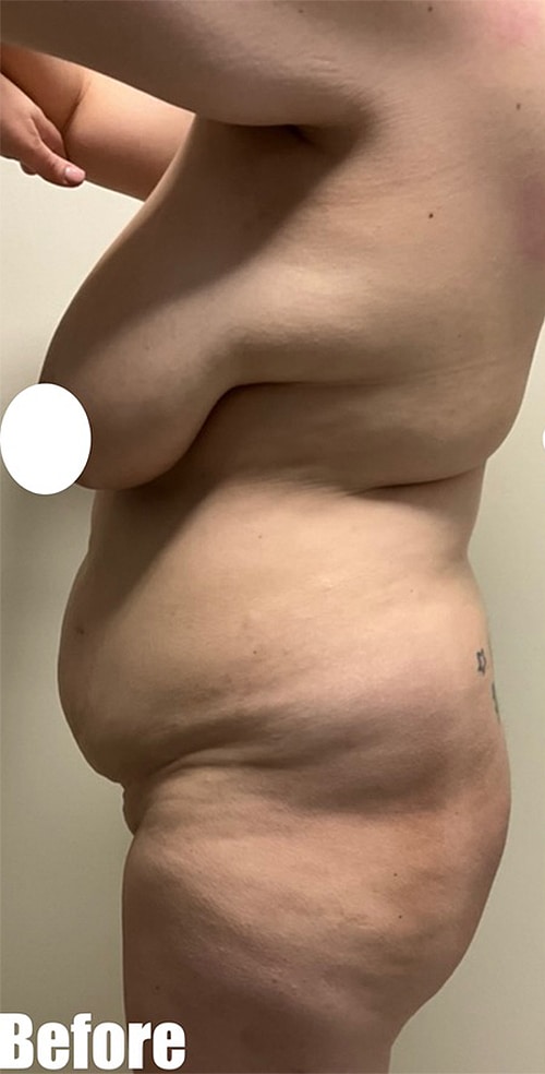 Before Image: 38F Mommy Makeover - left-side