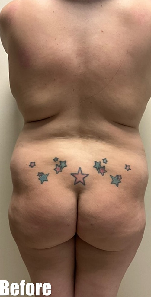 Before Image: 38F Mommy Makeover - back
