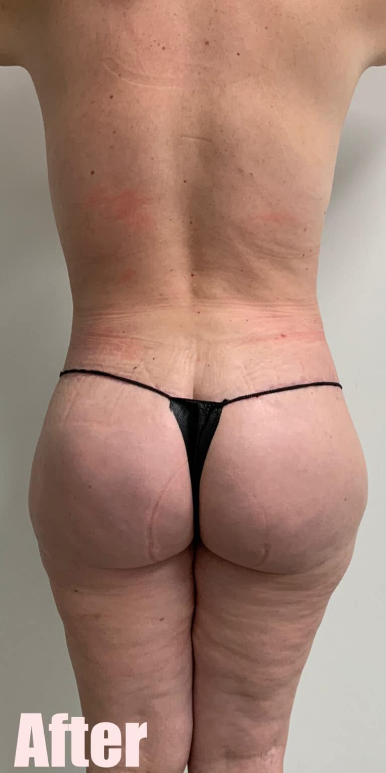 After Image: 43F Circumferential Mamacita Makeover - back