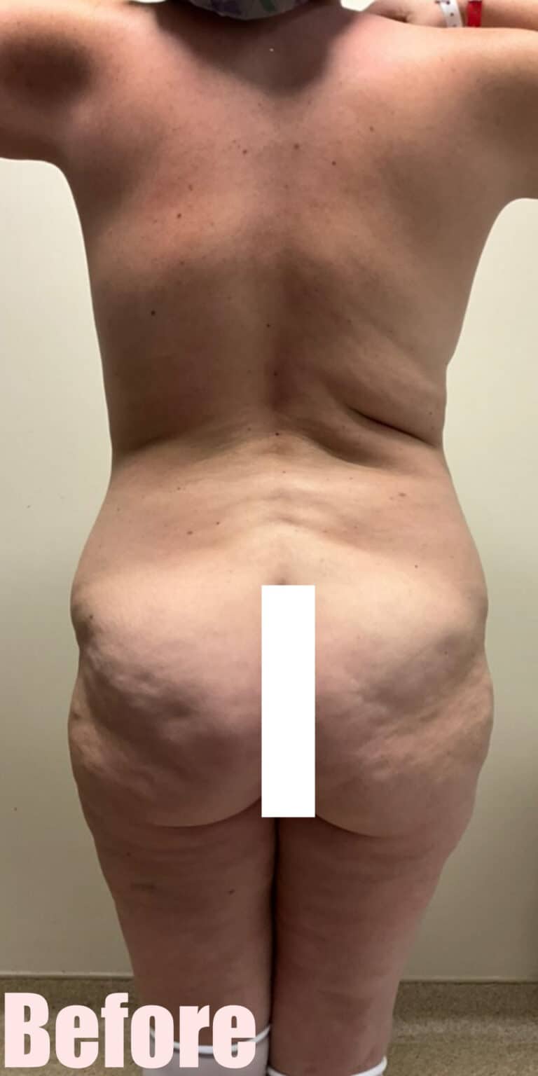 Before Image: 43F Circumferential Mamacita Makeover - back