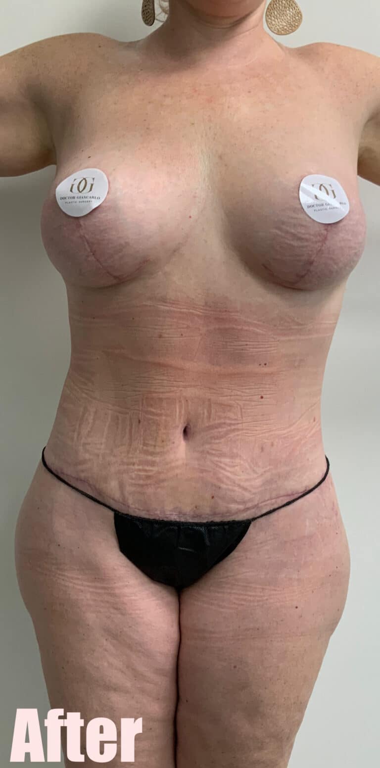 After Image: 43F Circumferential Mamacita Makeover - front