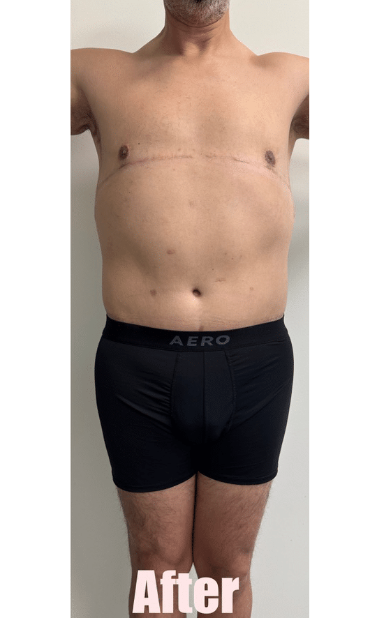 After Image: 48M Male Chest Contouring with Free Nipple Graft, Circumferential Tummy Tuck - front
