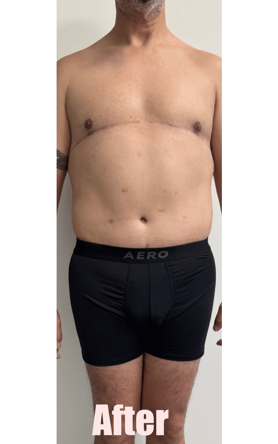 After Image: 48M Male Chest Contouring with Free Nipple Graft, Circumferential Tummy Tuck - front