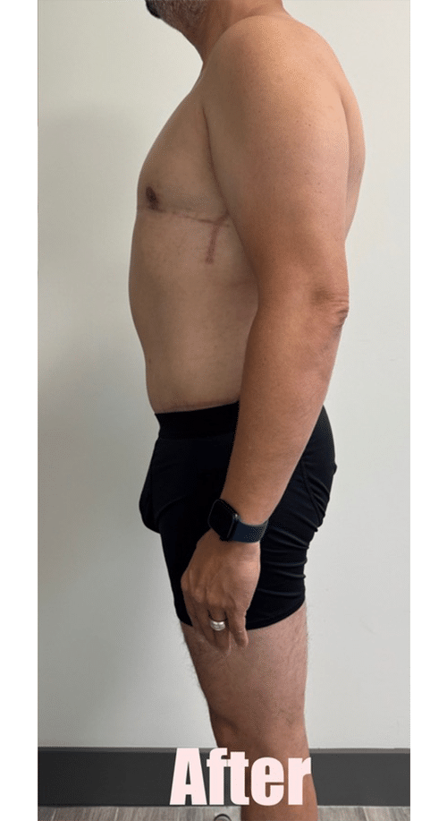 After Image: 48M Male Chest Contouring with Free Nipple Graft, Circumferential Tummy Tuck - left-side