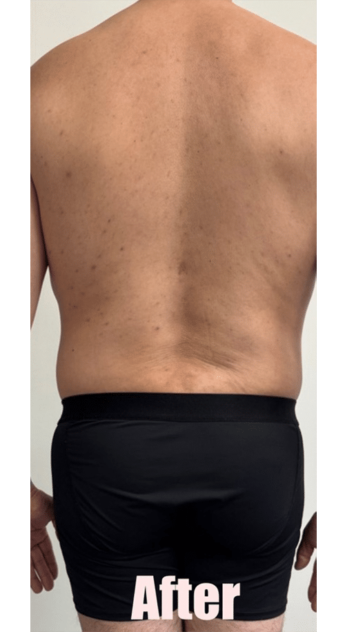 After Image: 48M Male Chest Contouring with Free Nipple Graft, Circumferential Tummy Tuck - back