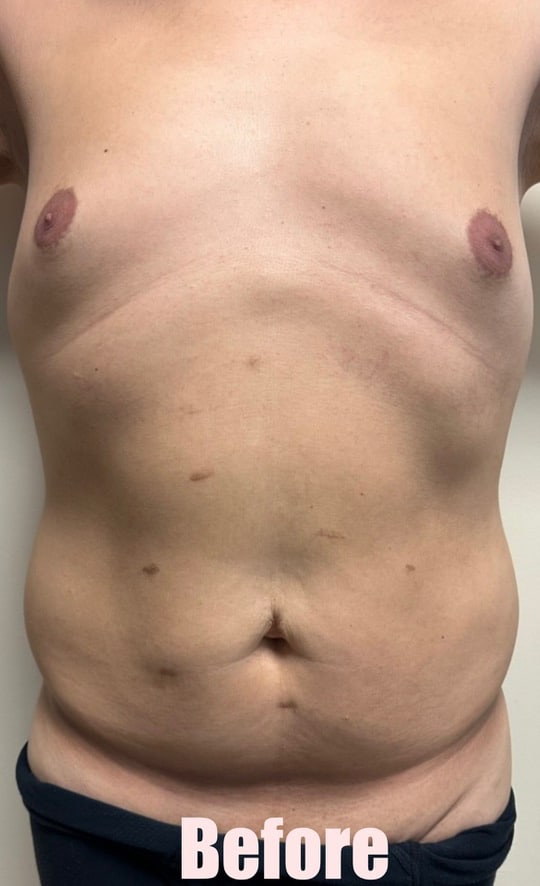 Before Image: 48M Male Chest Contouring with Free Nipple Graft, Circumferential Tummy Tuck - front