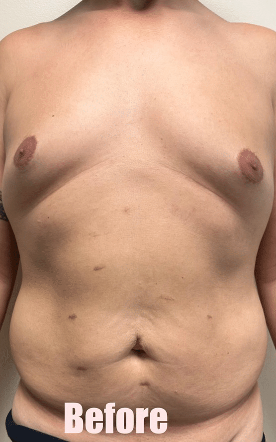 Before Image: 48M Male Chest Contouring with Free Nipple Graft, Circumferential Tummy Tuck - front
