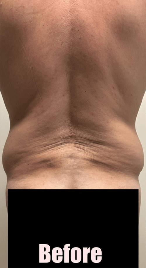 Before Image: 48M Male Chest Contouring with Free Nipple Graft, Circumferential Tummy Tuck - back
