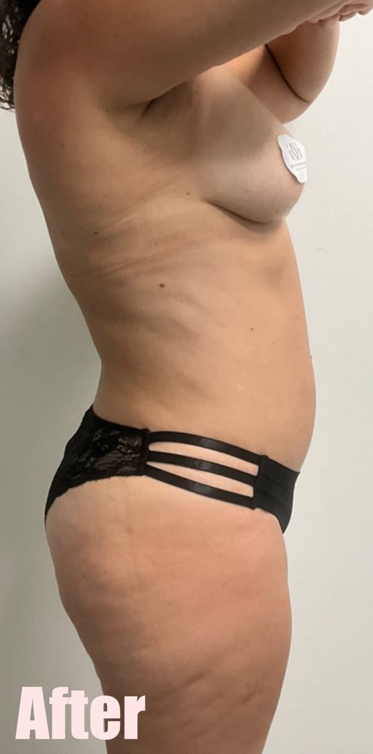 After Image: Mommy Makeover with Breast Lift and Fat Transfer, Tummy Tuck and Lipo 360 - right-side