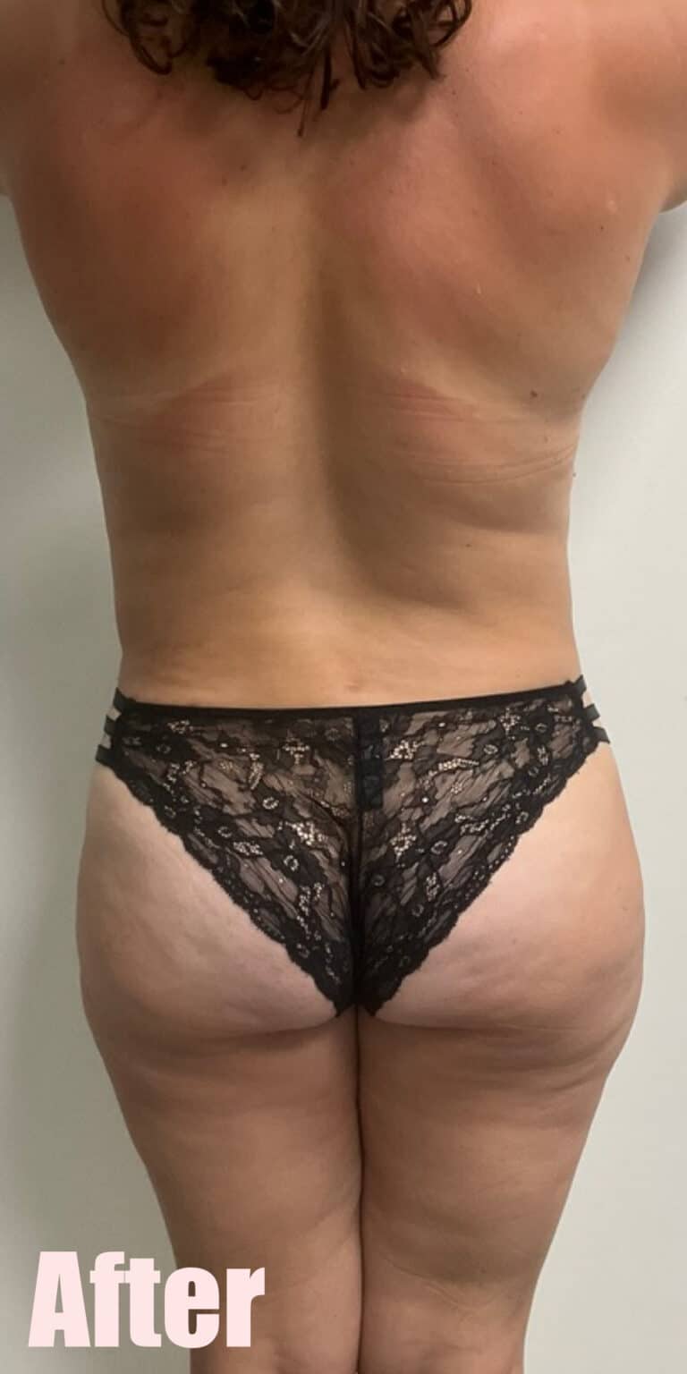 After Image: Mommy Makeover with Breast Lift and Fat Transfer, Tummy Tuck and Lipo 360 - back