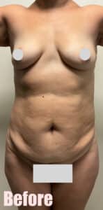 Before Image: Mommy Makeover with Breast Lift and Fat Transfer, Tummy Tuck and Lipo 360