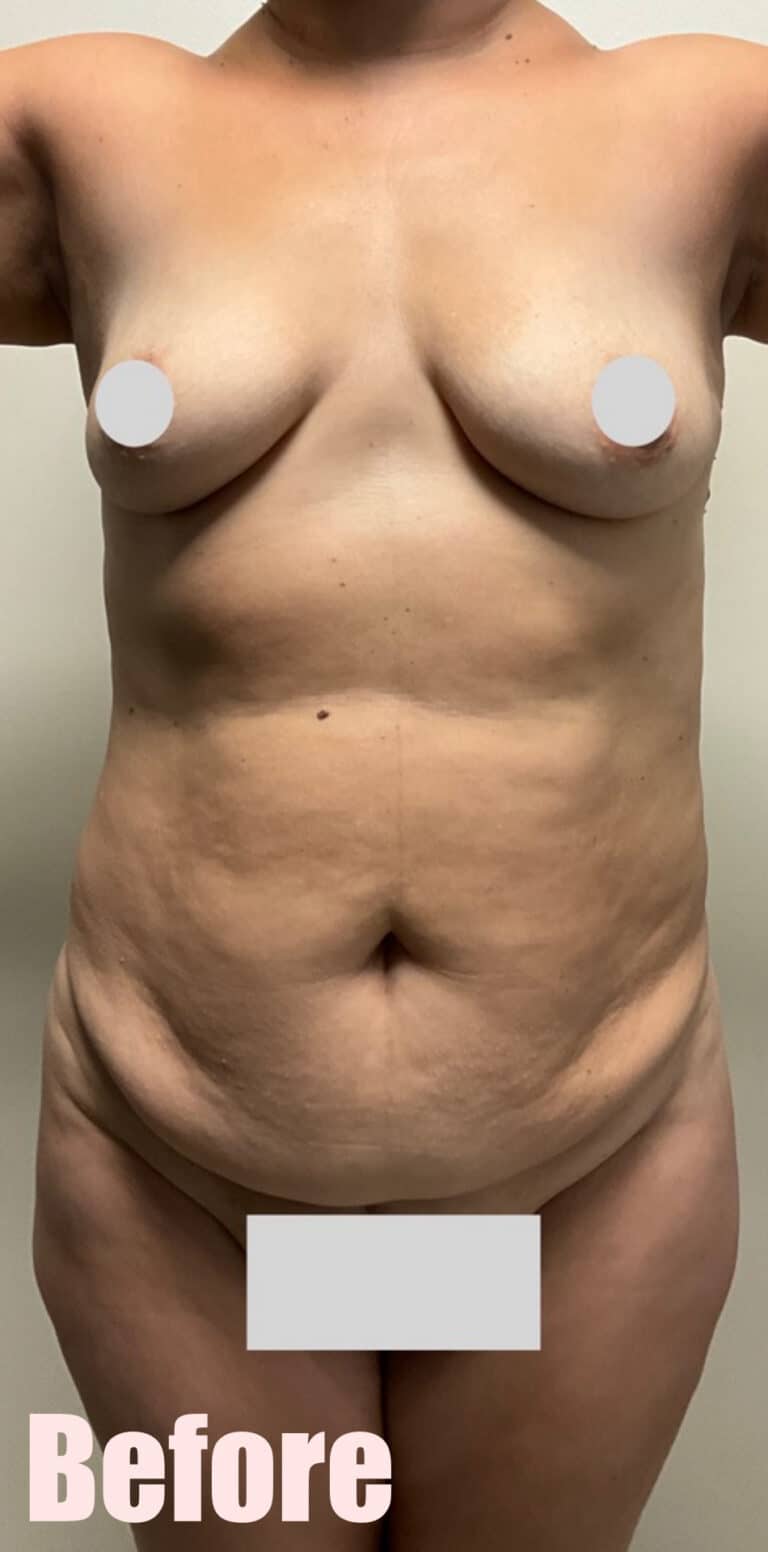 Before Image: Mommy Makeover with Breast Lift and Fat Transfer, Tummy Tuck and Lipo 360 - front