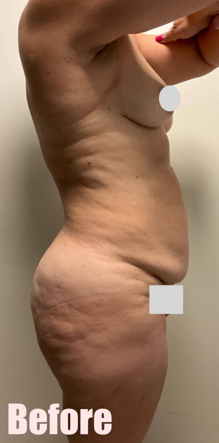 Before Image: Mommy Makeover with Breast Lift and Fat Transfer, Tummy Tuck and Lipo 360 - right-side