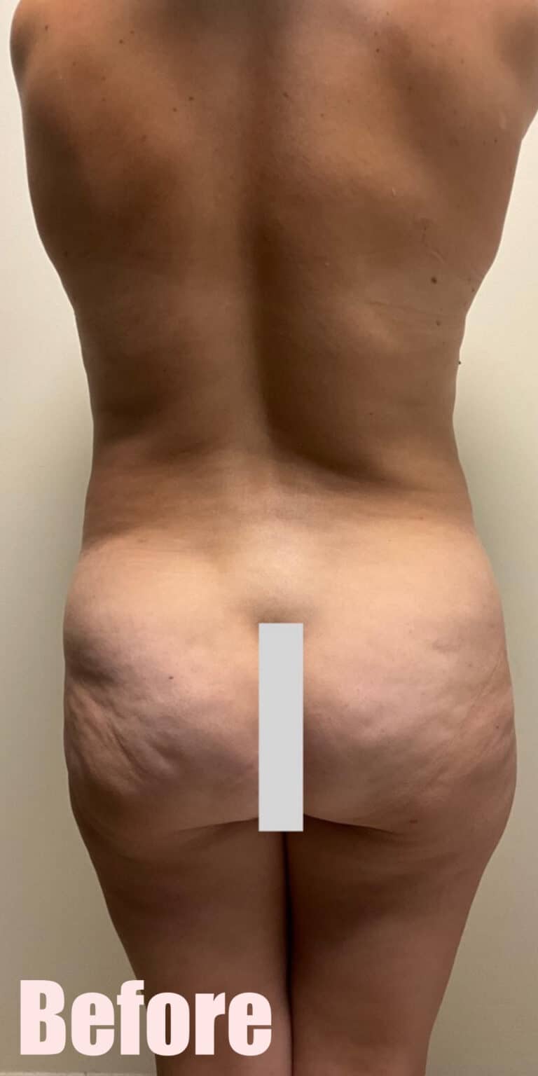 Before Image: Mommy Makeover with Breast Lift and Fat Transfer, Tummy Tuck and Lipo 360 - back