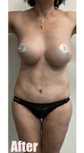 After Image: Fleur De Lis Abdominoplasty