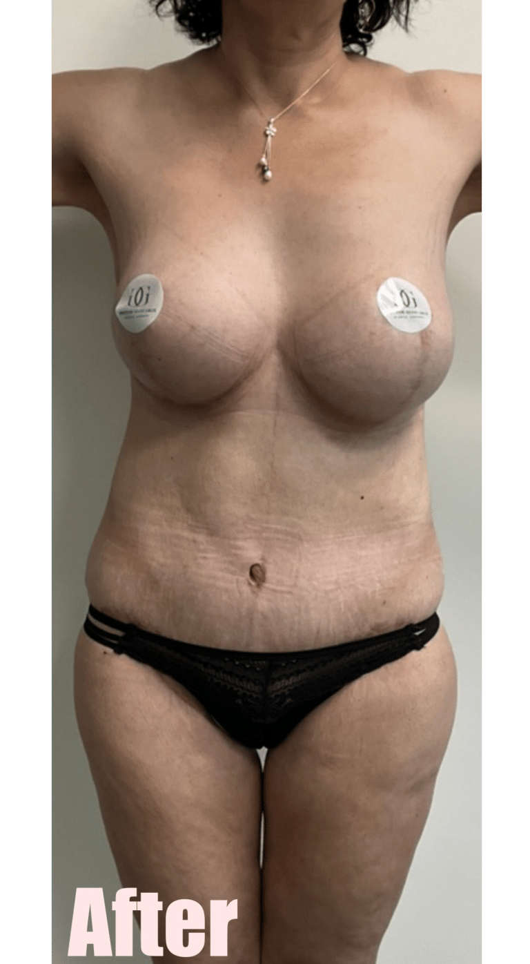 After Image: Fleur De Lis Abdominoplasty - front