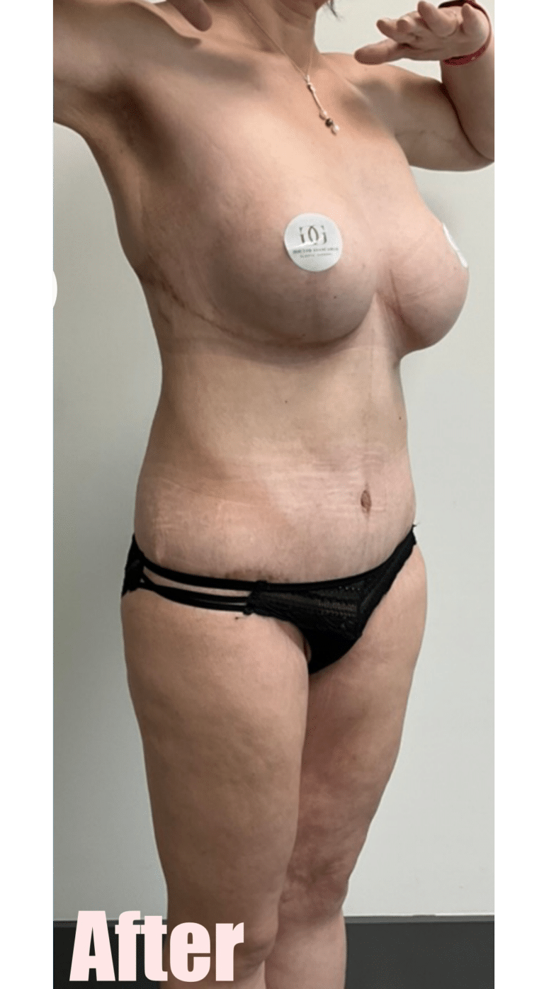 After Image: Fleur De Lis Abdominoplasty - right-front-oblique