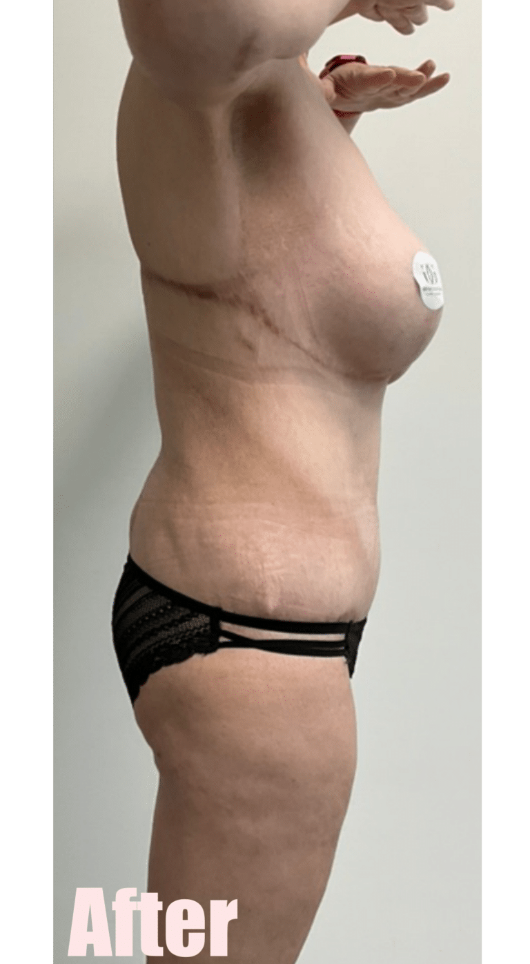 After Image: Fleur De Lis Abdominoplasty - right-side
