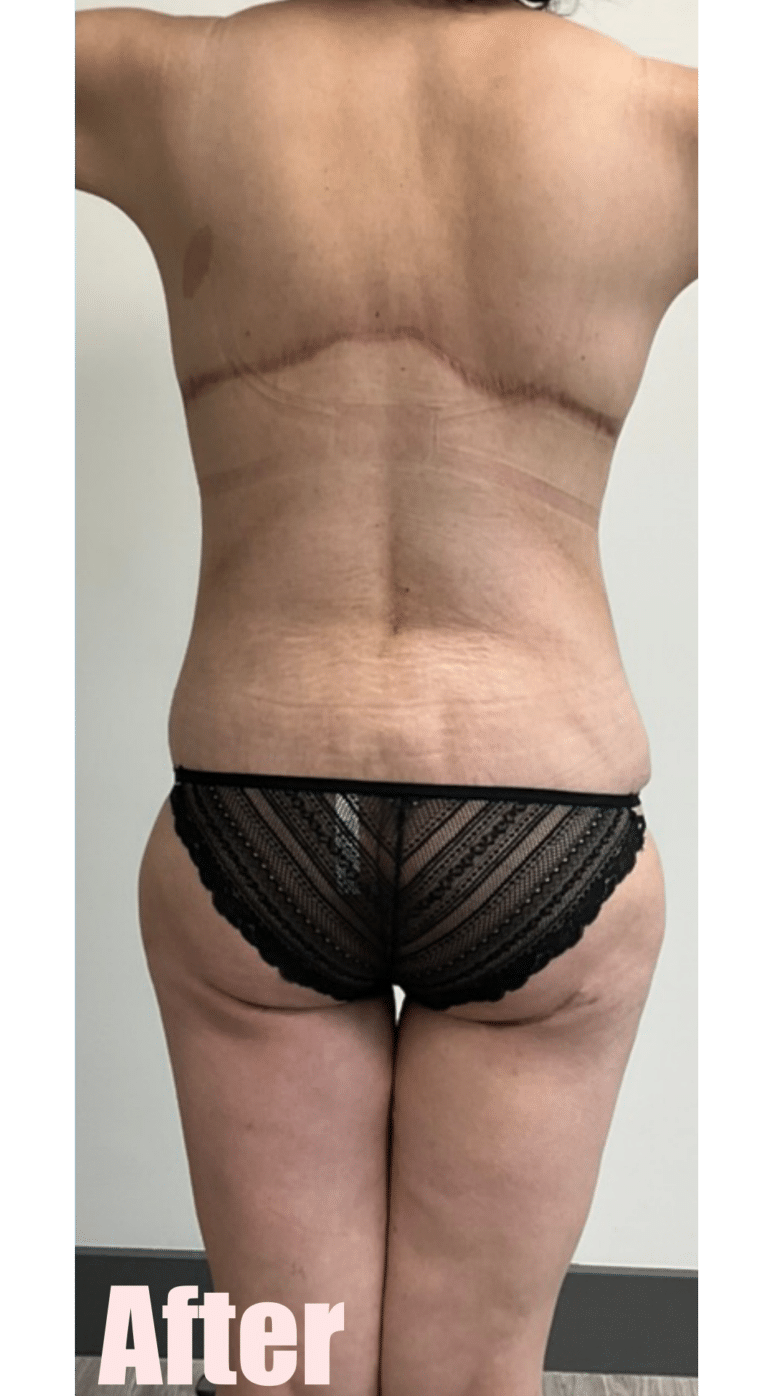 After Image: Fleur De Lis Abdominoplasty - back