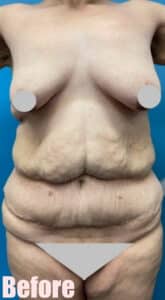 Before Image: Fleur De Lis Abdominoplasty