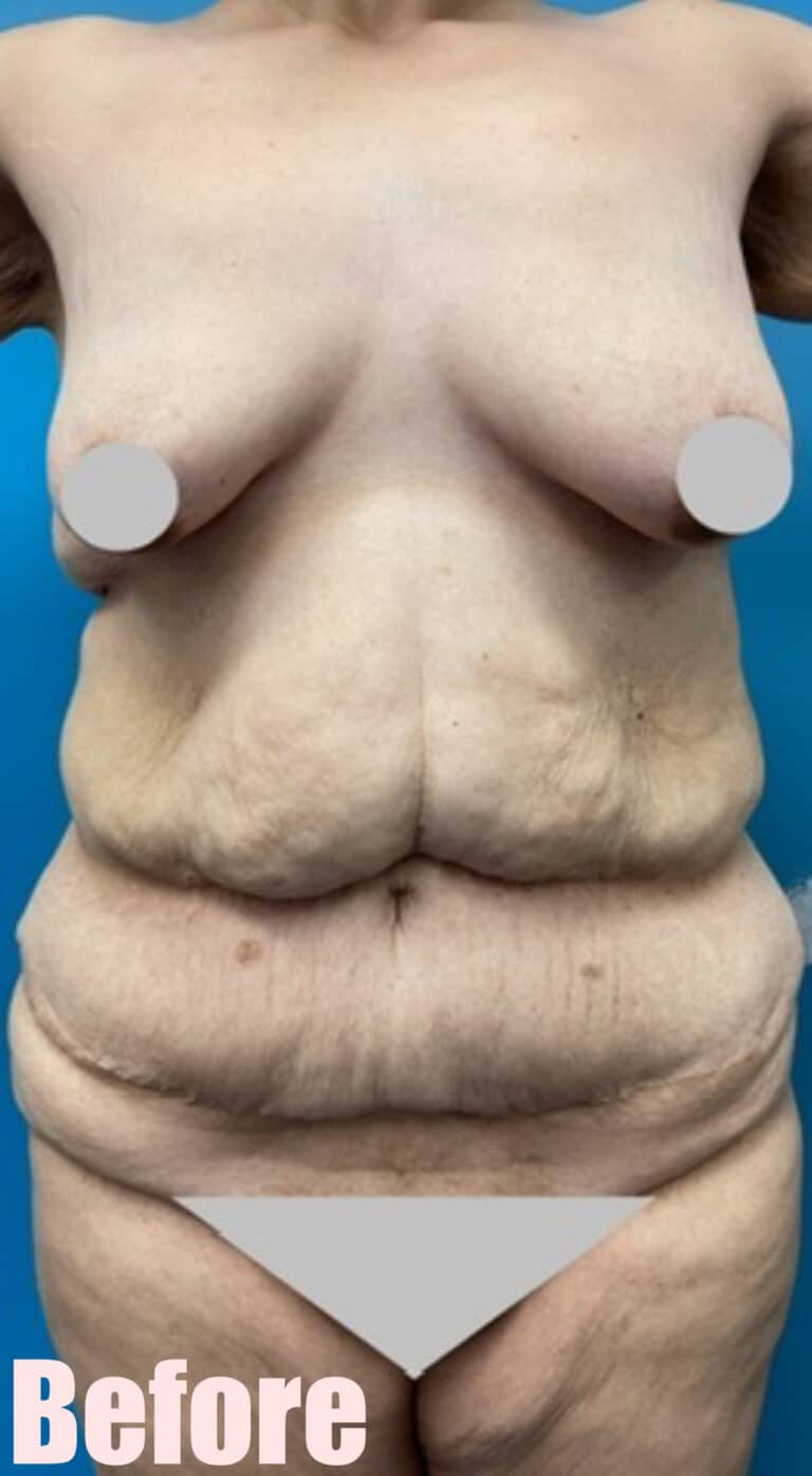 Before Image: Fleur De Lis Abdominoplasty - front