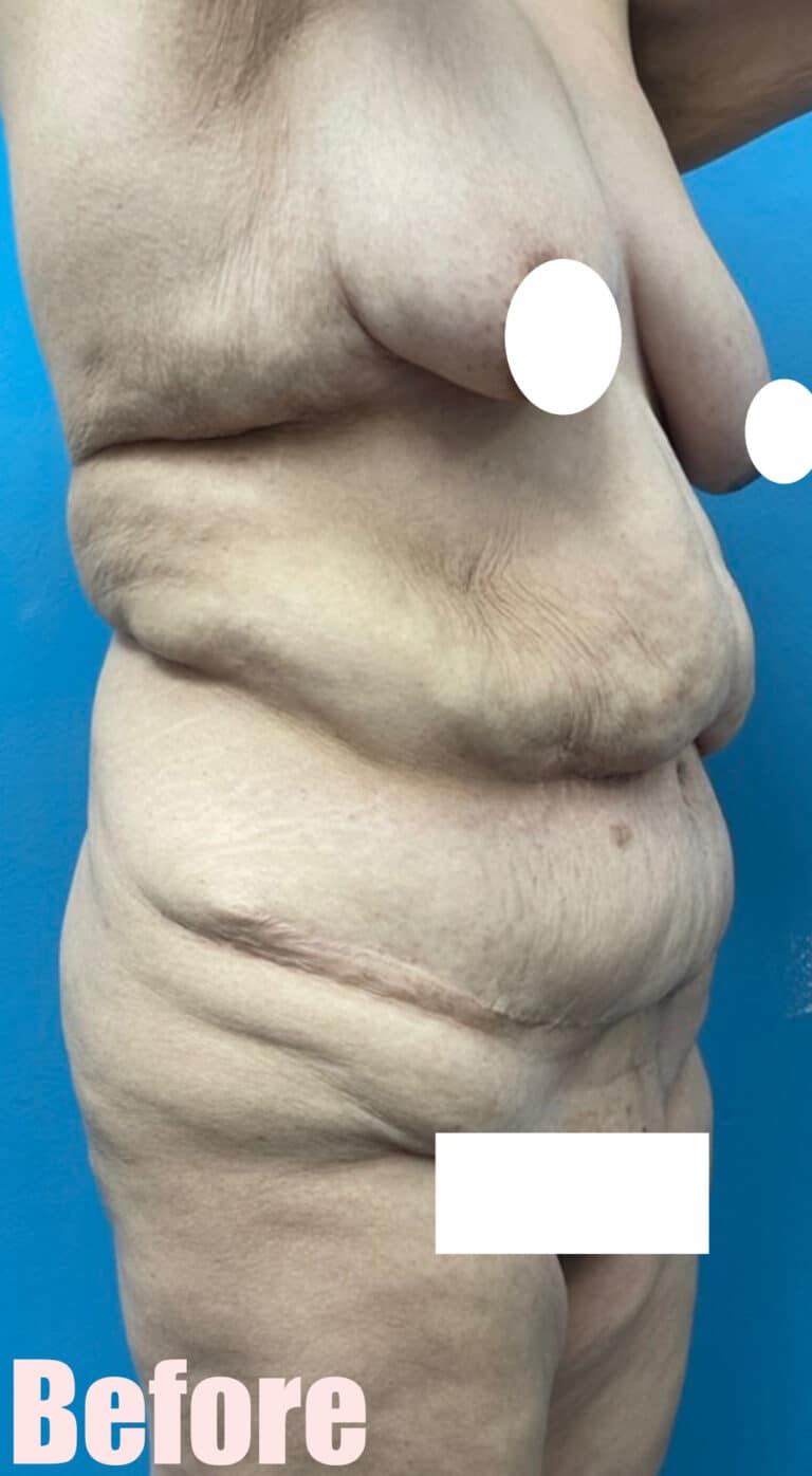 Before Image: Fleur De Lis Abdominoplasty - right-front-oblique